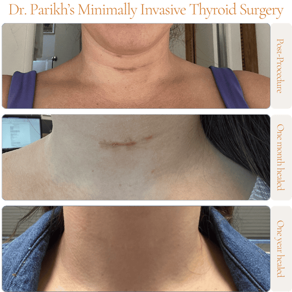 Dr. Parikh's Minimally Invasive Thyroid Surgery, showing small incision scars post-procedure, one month later, and totally invisible scar one year healed