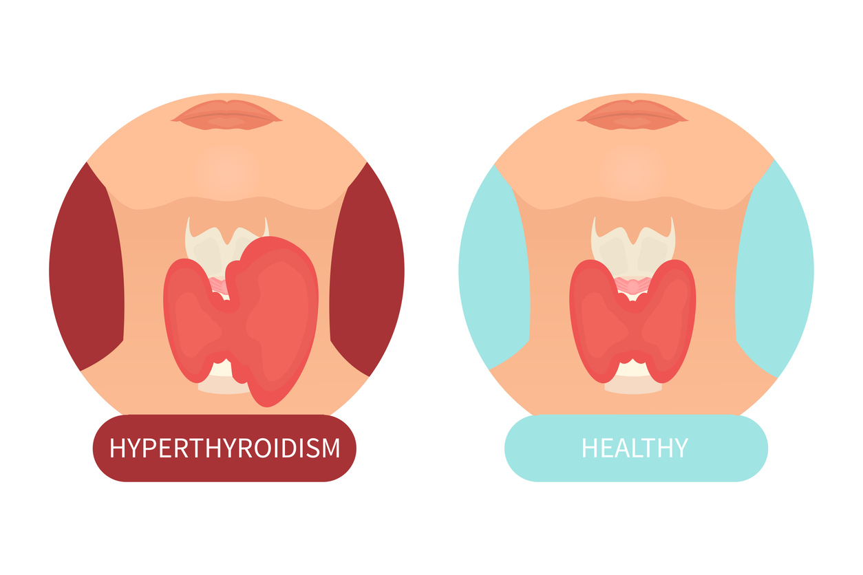 Hyperthyroidism vs Healthy Thyroid